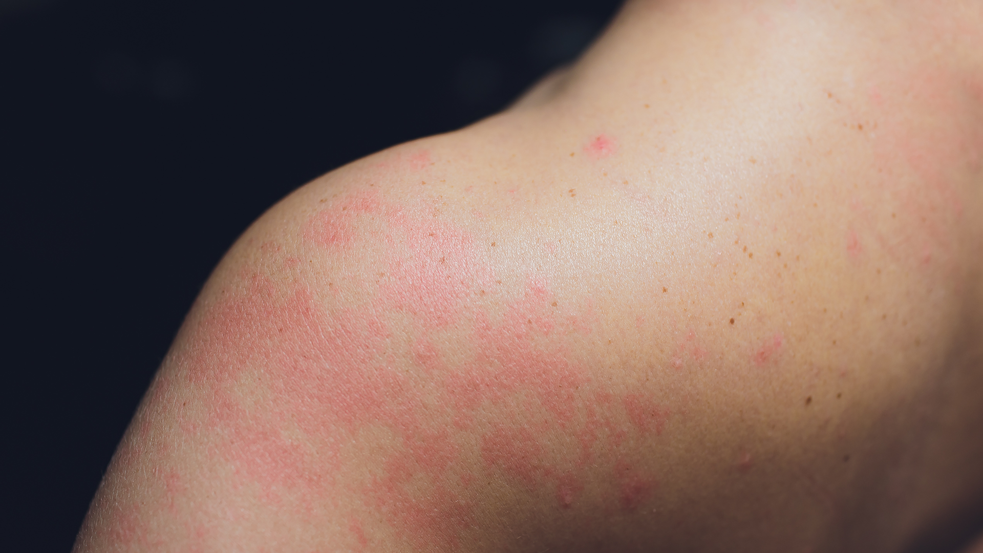 Alergia rozpoznana w skórze